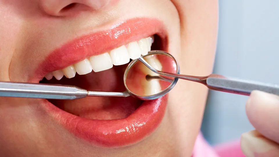 Profesional realizando una limpieza dental